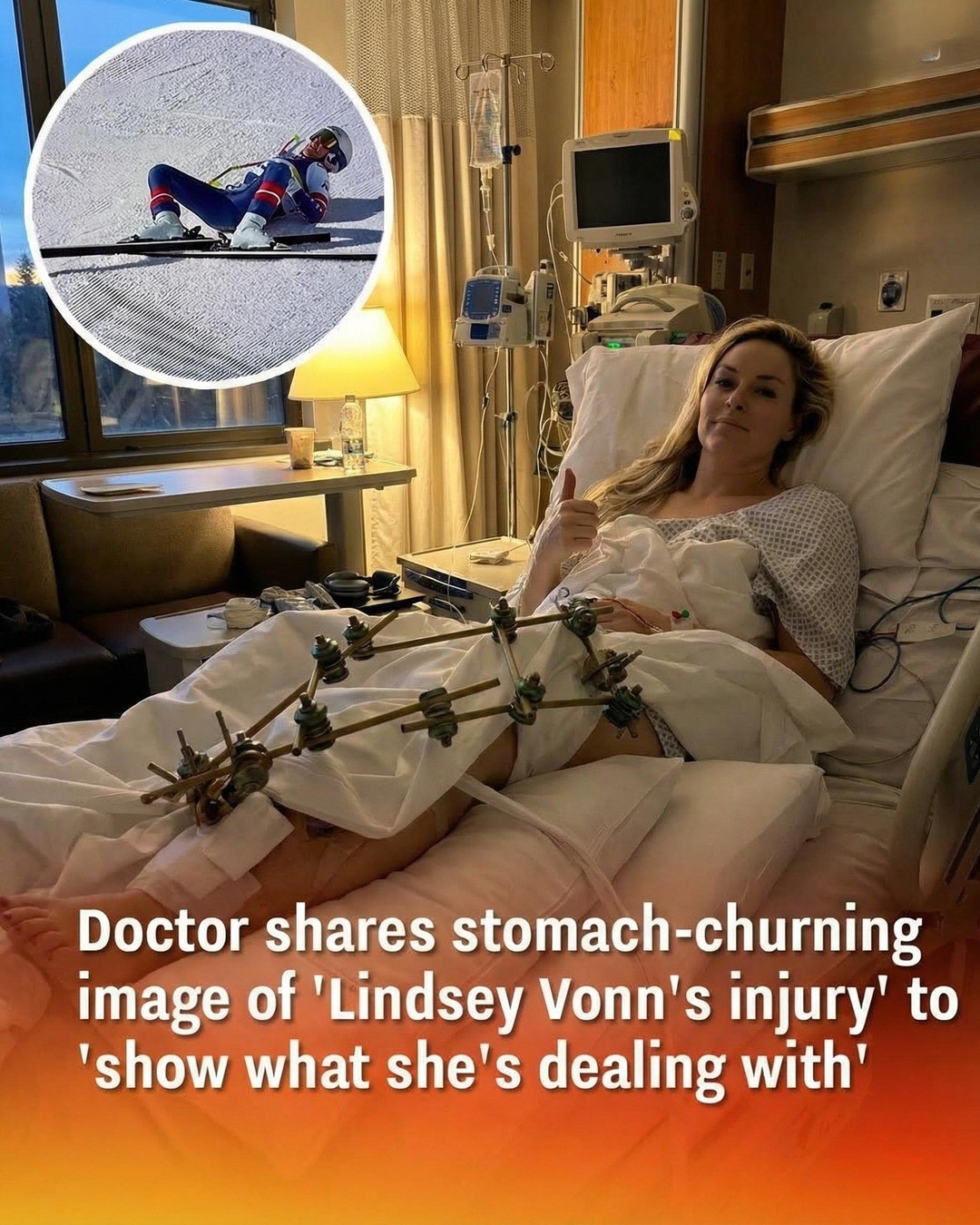 Doctor Explains the Serious Injury Lindsey Vonn Experienced and What Recovery Involves! – Story Of The Day!
