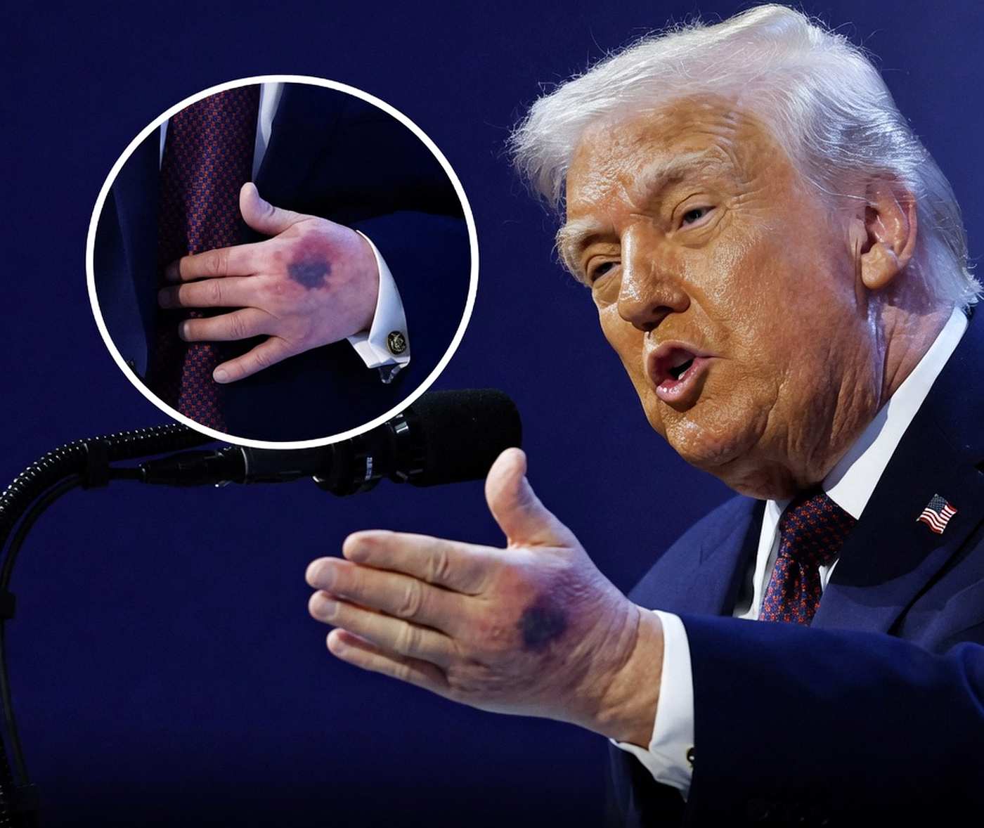 The Mystery of the Mark, Why a Simple Bruise on Trump Hand Sparked a National Firestorm – usanews.net